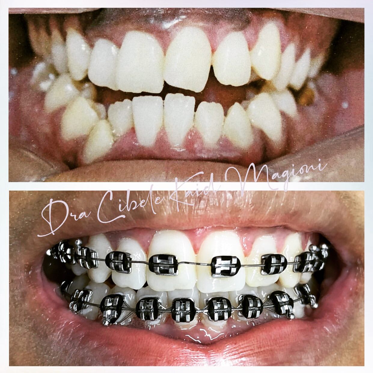 Estética e Harmonização do Sorriso (antes e depois)